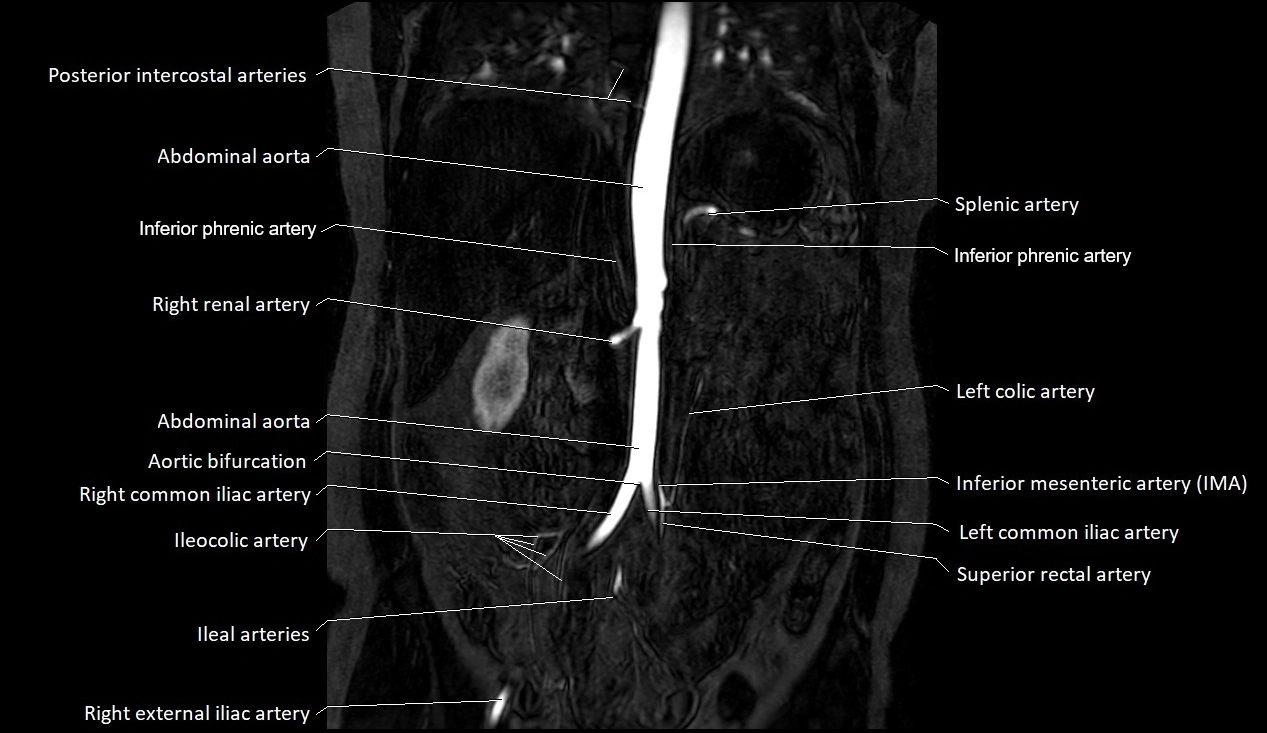 MRA Abdomen coronal anatomy image 20.webp
